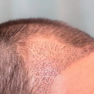 زراعة شعر